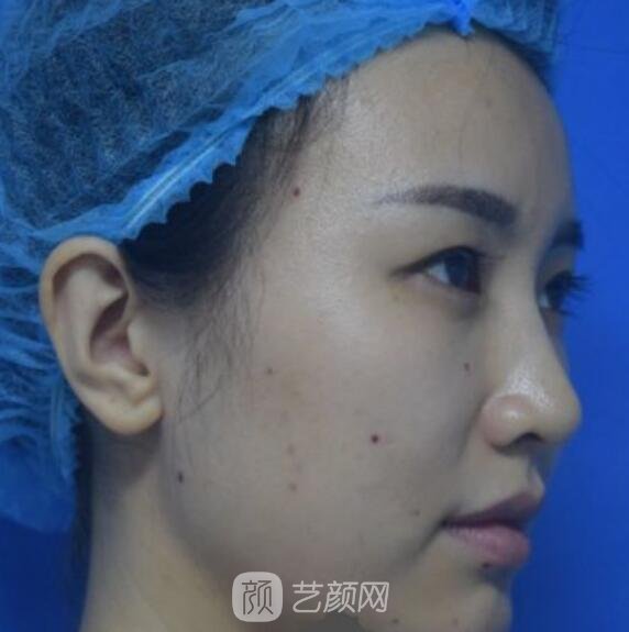 自體脂肪填充術前照片