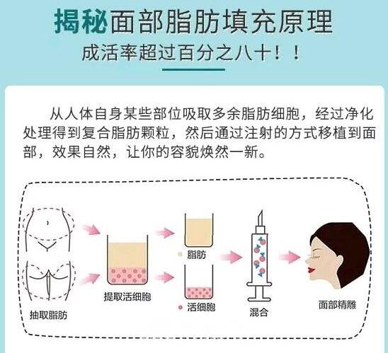 自體脂肪填充的過程步驟