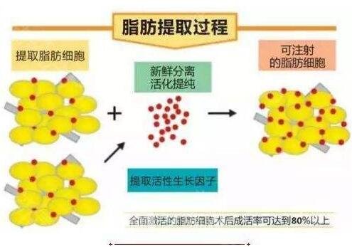 提取自體脂肪的過程
