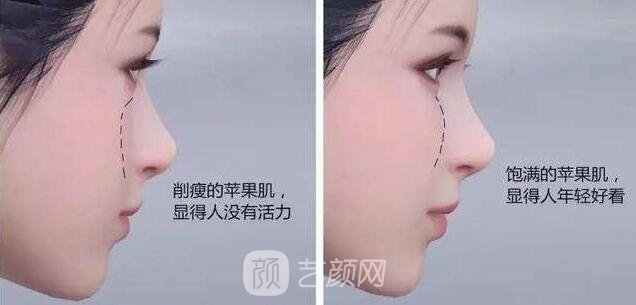 自體脂肪填充蘋(píng)果肌