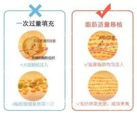 脂肪填充術(shù)后要注意忌口，忌辛辣刺激性食物