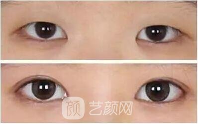 埋線雙眼皮果圖