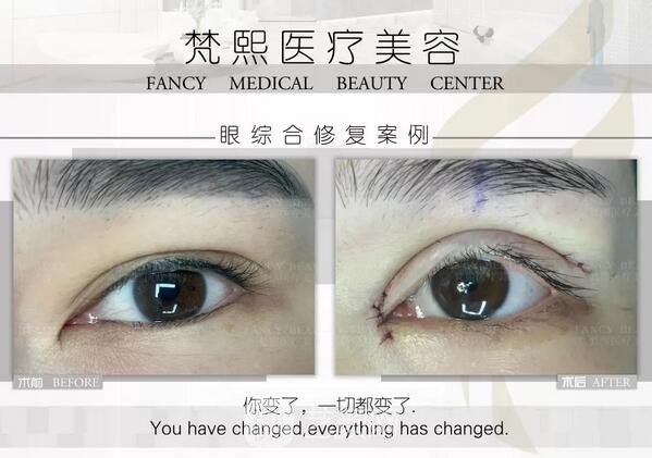 雙眼皮修復(fù)