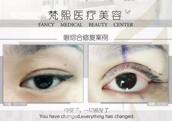 雙眼皮修復(fù)案例圖