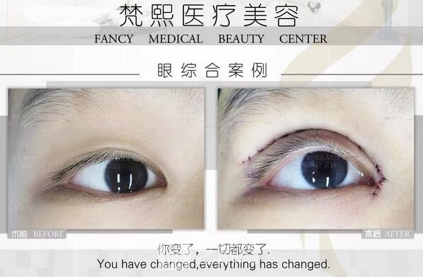 雙眼皮整形案例