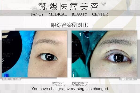 雙眼皮整形案例