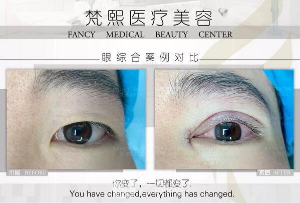 雙眼皮整形案例果圖