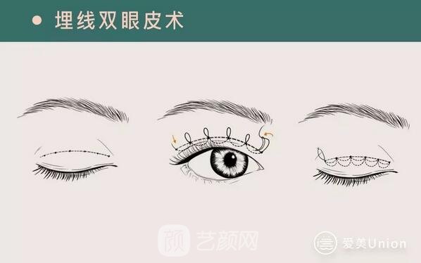 埋線雙眼皮手術(shù)