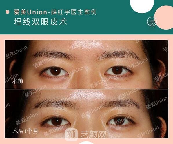 埋線雙眼皮手術(shù)案例圖