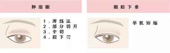 常見的雙眼皮形態(tài)