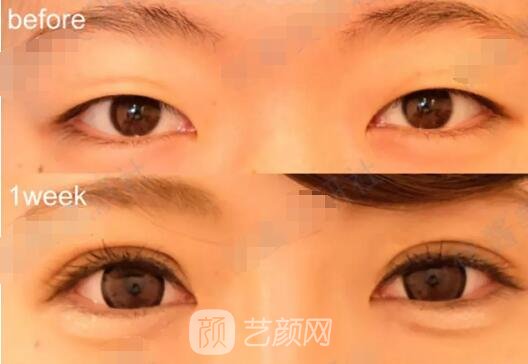全切雙眼皮案例果圖