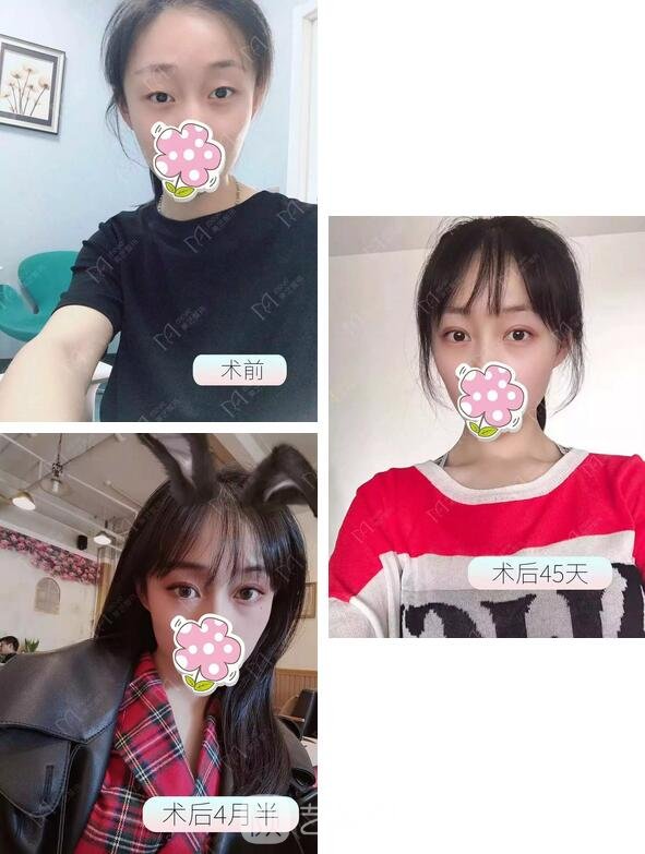 全切雙眼皮+眶隔人體脂肪釋放+開內(nèi)眼角