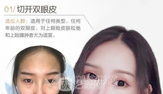 雙眼皮手術(shù)怎么做