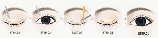 微創(chuàng)雙眼皮手術原理