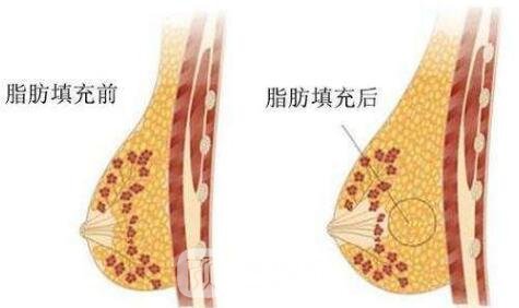 自體脂肪填充填充的價格多少呢?