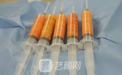 自體脂肪填充填充的價格多少呢?