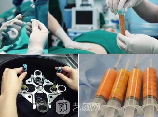 自體脂肪豐胸手術(shù)后的常見問題