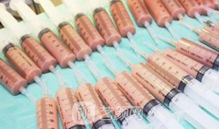 自體脂肪豐胸手術(shù)后的常見問題