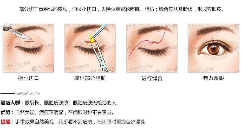 割雙眼皮微創(chuàng)好還是全切好？