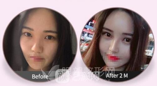 割雙眼皮后多久可以化妝