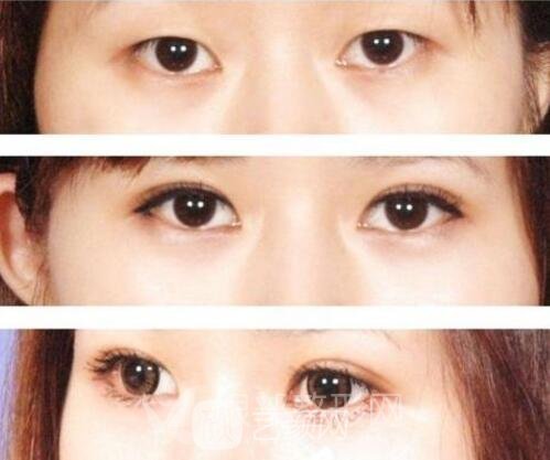 雙眼皮埋線法果怎么樣？