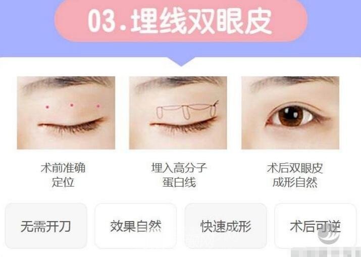 拉線雙眼皮是埋線嗎？