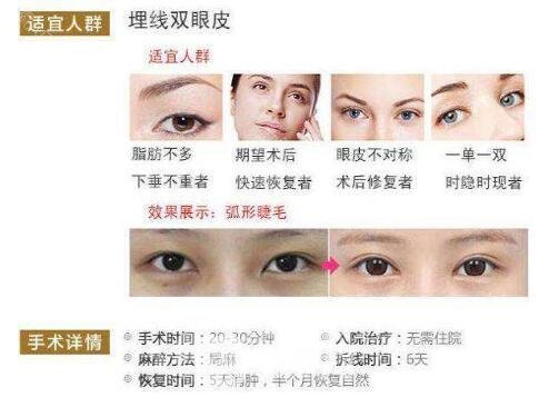 拉線雙眼皮是埋線嗎？適合哪些人？