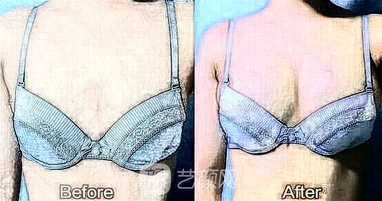 自體脂肪隆胸術(shù)有哪些禁忌？