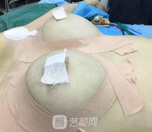 假體隆胸術(shù)后一定要做好護(hù)理工作哦!