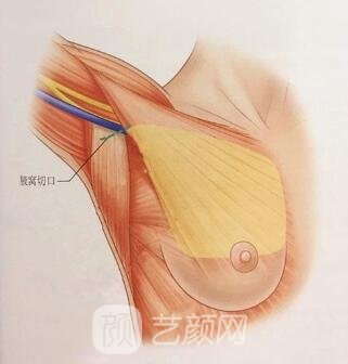 不一樣的豐胸手術(shù)痛疼水平大不一樣