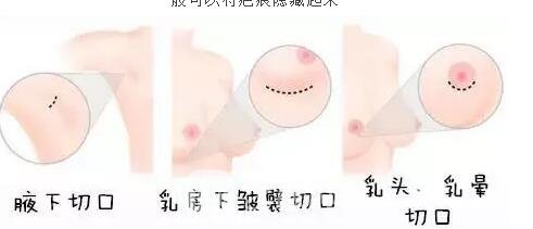 胸部敏感度會(huì)受隆胸手術(shù)的影響嗎？