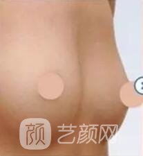 胸部敏感度會(huì)受隆胸手術(shù)的影響嗎？