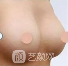 胸部敏感度會(huì)受隆胸手術(shù)的影響嗎？