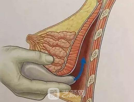胸部敏感度會(huì)受隆胸手術(shù)的影響嗎？