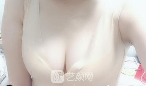 真實影響造成胸部下垂的要素是什么？