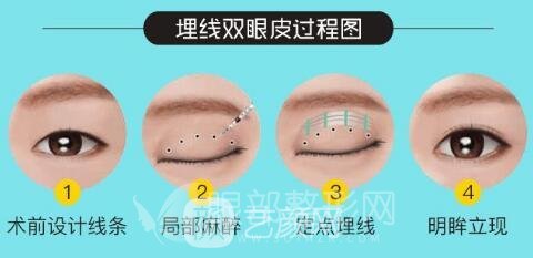 眼部微整形：重瞼術(shù)+祛除魚(yú)尾紋+祛眼袋，要不要來(lái)一套！