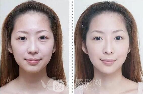 去眼袋手術(shù)果 術(shù)前術(shù)后