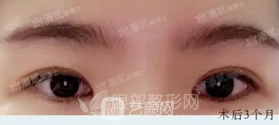 韓式小切口雙眼皮案例圖，術(shù)后3個月果圖