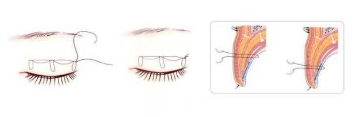 埋線雙眼皮手術(shù)原理圖