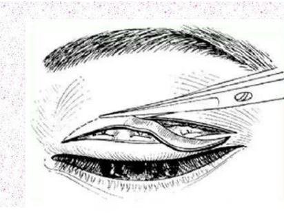 全切雙眼皮手術(shù)原理圖