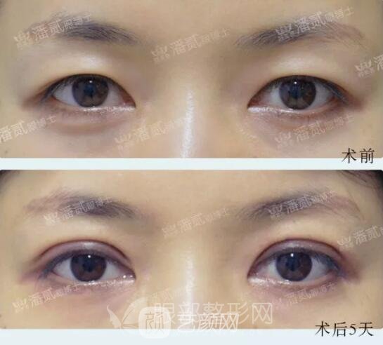 全切雙眼皮果圖，術(shù)后5天