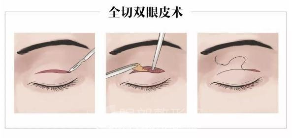 割雙眼皮較全攻略，術(shù)前你一定要get的知識！