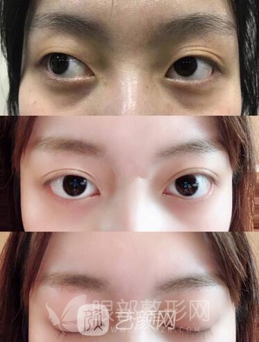 埋線雙眼皮真人案例圖