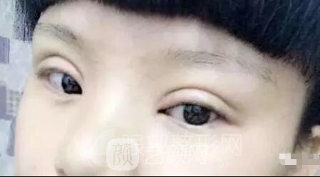 雙眼皮手術(shù)失敗