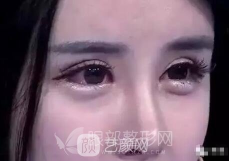 雙眼皮失敗 假深寬