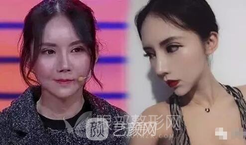 雙眼皮過寬 疤痕