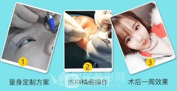 雙眼皮手術(shù)過程