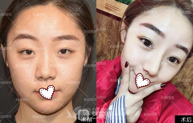 開眼角多久恢復(fù)？醫(yī)生告訴我至少需要30天！