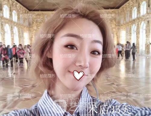 開眼角術(shù)后恢復(fù)過程圖 真人案例