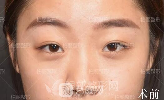 開眼角多久恢復(fù) 真人案例分享